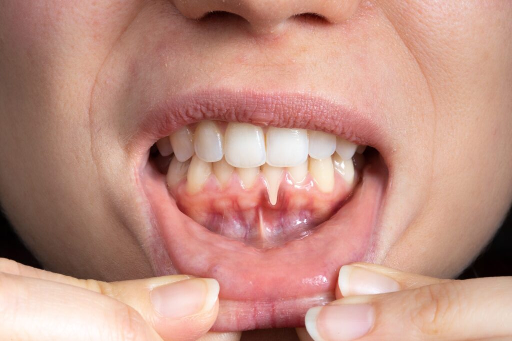 Preparing for teeth whitening with receding gums Maidstone